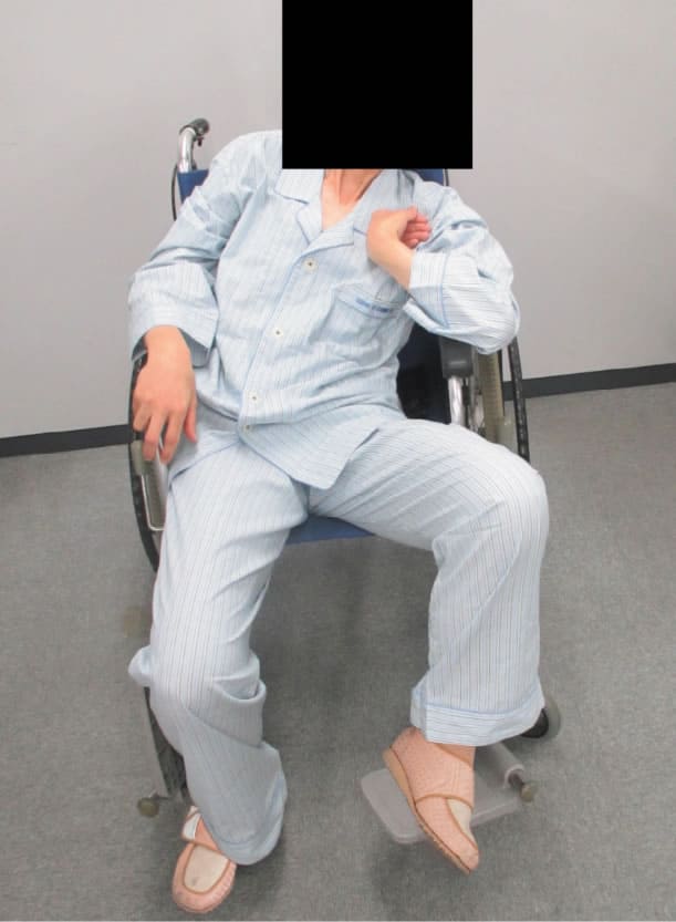 車椅子での座位の姿勢を下に示す。 このような姿勢を長時間続けることで最も褥瘡が発生しやすい部位はどれか。
