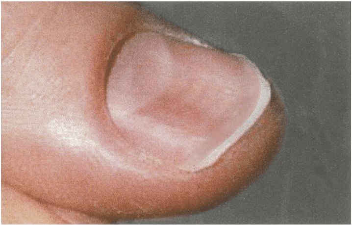 貧血〈 anemia 〉を伴う患者の爪の写真を別に示す。欠乏している栄養素はどれか。