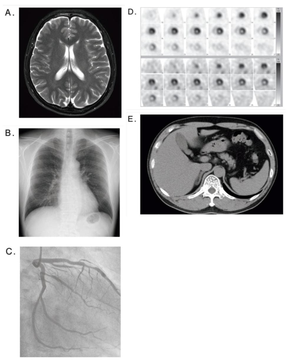 検査の画像を示す。 狭心症（angina pectoris）の手術に最も重要な検査はどれか。