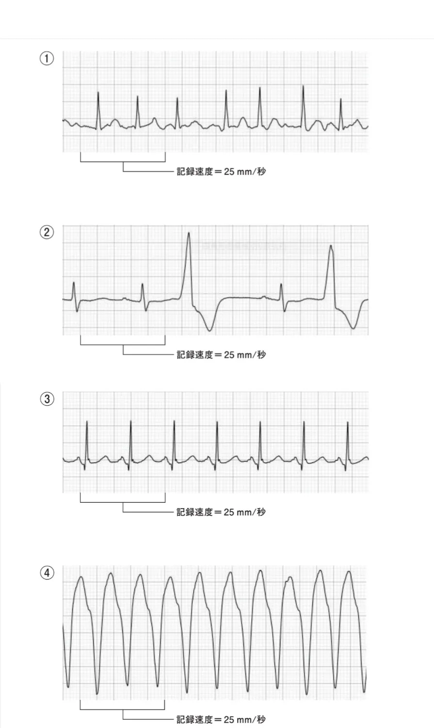 心電図波形を以下に示す。心室頻拍（ventricular tachycardia）はどれか。